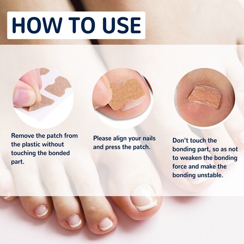 NailLift™ – Correctiepads voor Ingegroeide Teennagels | 1+1 Gratis