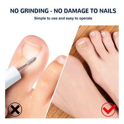 NailLift™ – Correctiepads voor Ingegroeide Teennagels | 1+1 Gratis