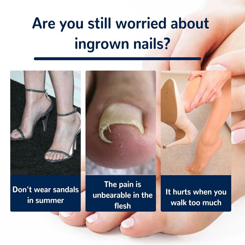 NailLift™ – Correctiepads voor Ingegroeide Teennagels | 1+1 Gratis