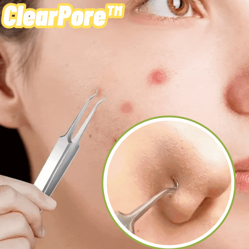 ClearPore™ Mee-eter Verwijderset – Professioneel Pincet voor Acne & Poriën