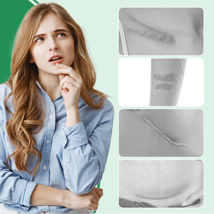 Scarify™ – Herbruikbare siliconen littekenpleisters voor een gave huid [1 + 1 Gratis]