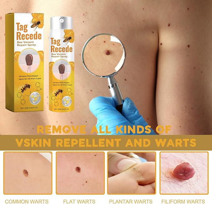 TagAway™ – Natuurlijke Wratten & Huidflapjes Verwijderaar Thuis