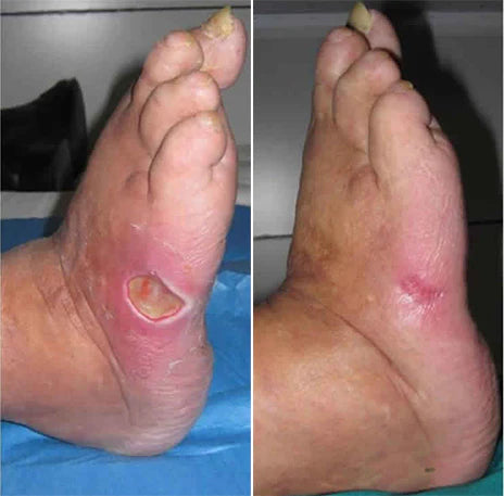 GlucoHeal™ – Hydrateert en beschermt [50% Korting]