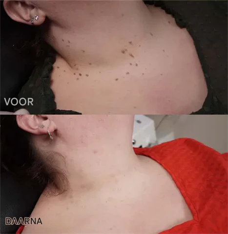 BeeNature™ – Verwijdert huidflapjes en vlekken zacht en effectief [1 + 1 Gratis]