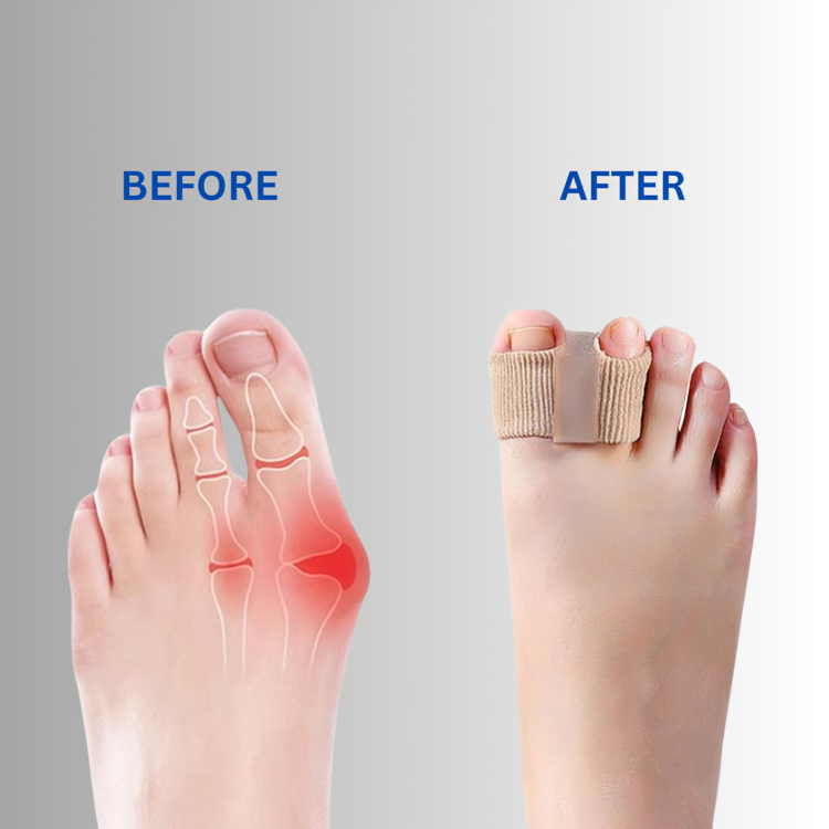 ToeCorrect™ – Zachte correctie van hallux & overlappende tenen [2 + 2 Gratis]
